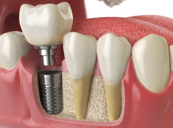 Зубная имплантация представляет собой общую процедуру восстановления отсутствующих зубов, не затрагивая соседние зубы.
