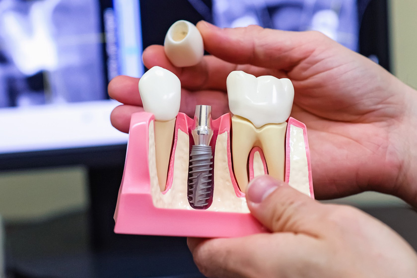 Иплантация зубов — что нужно знать?